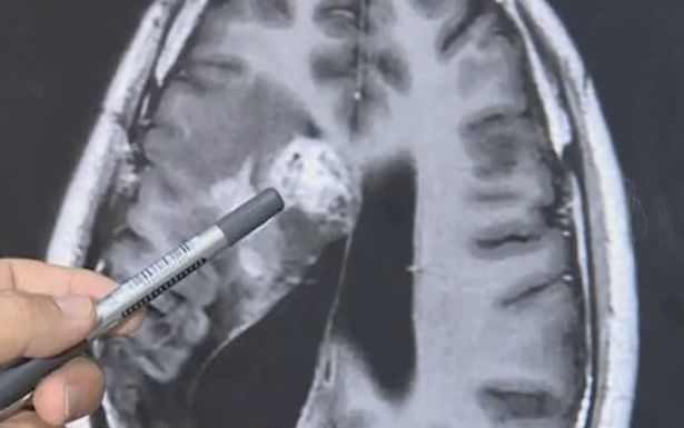 Homem retira verme de 12 cm que comia seu cérebro há 15 anos