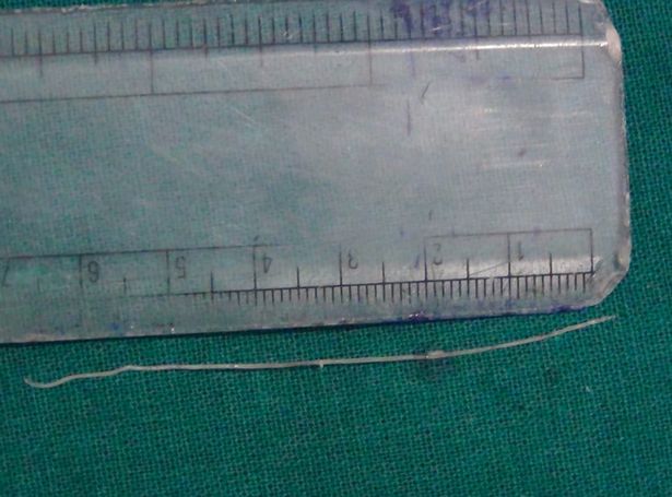 Verme de 7cm %c3%a9 retirado do olho de homem na %c3%adndia 2 • mundo sombrio