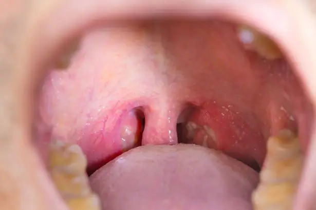 0 tonsil throat • mundo sombrio