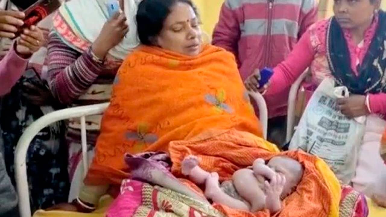 Bebê com quatro braços e quatro pernas nasce na índia